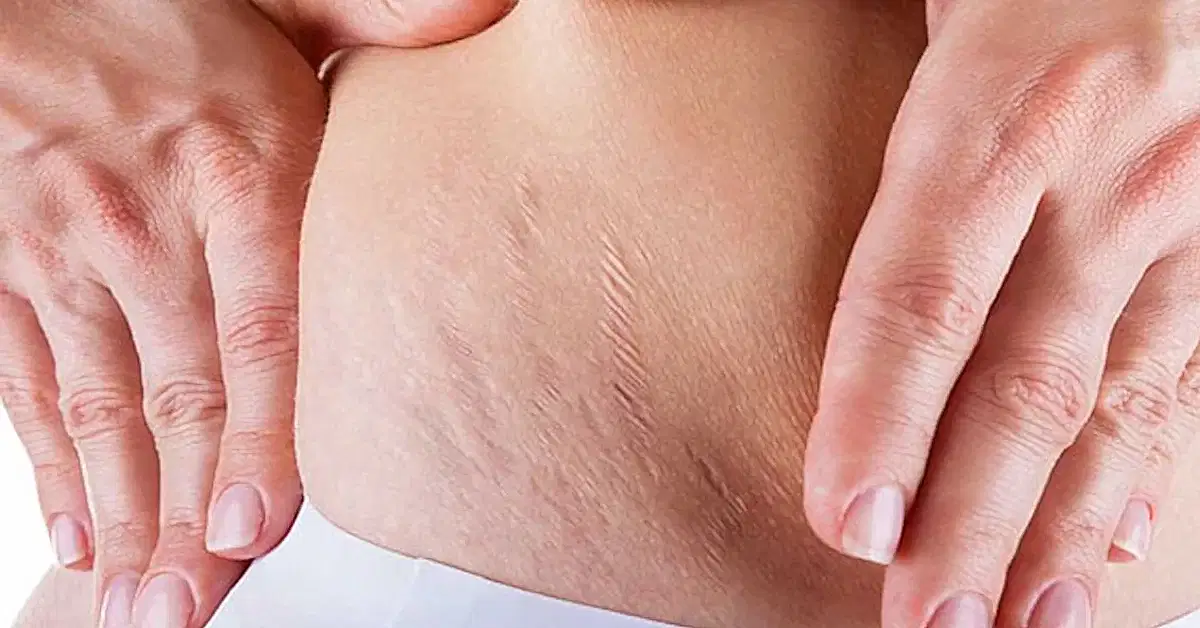 Striort Çatlak Onarım